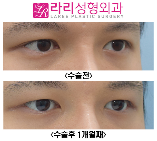 [Lari Plastic Surgery] Before and After of Double Eyelid Reversal Surgery, Which Can Also Remove a Hidden Double Eyelid image 4