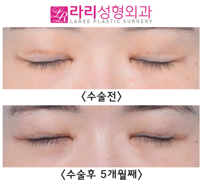 [Lari Plastic Surgery] Lowering the Double Eyelid Line to Near Single Eyelid Level: Before-and-After Photos of a Low Crease Revision image 4