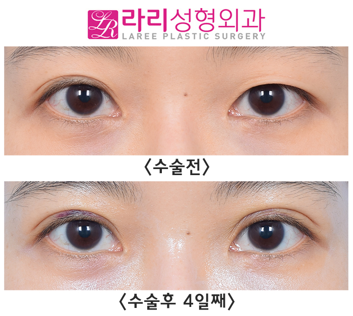 [Lari Plastic Surgery] Correcting Uneven Eyes with Non-Incisional Revision Surgery image 2