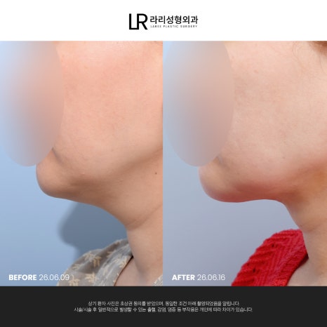 [라리성형외과] 이중턱 지방 흡입만으로는 아쉬운 얼굴 라인, 이중턱 근육 묶기도 같이 하면 효과가 두 배! 관련 이미지 10