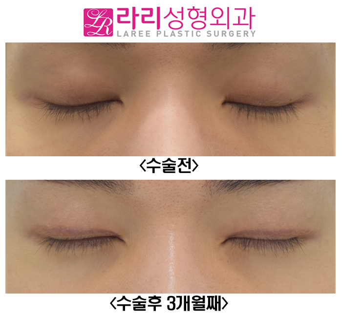 [라리성형외과] 졸려 보이는 자연쌍꺼풀, 아웃라인을 무쌍에 가까운 속쌍꺼풀로 또렷하게 만들기 관련 이미지 4