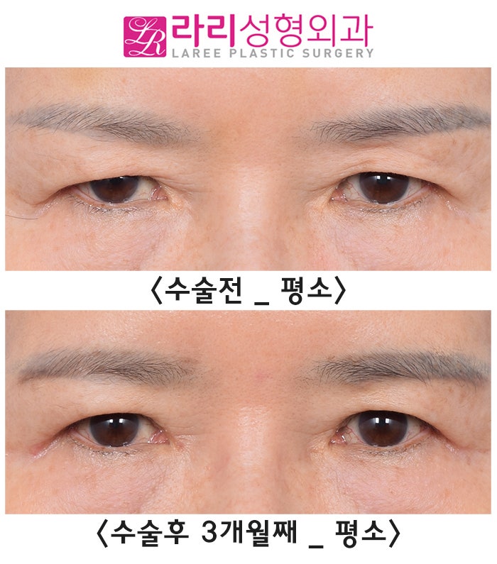 [Rari Plastic Surgery] Why You Should Get Forehead Botox Before Upper Blepharoplasty, as Seen in Before-and-After Photos image 3