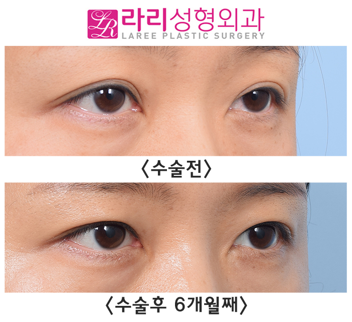 [라리성형외과] 흐릿한 눈, 소세지 쌍꺼풀 인라인 속쌍으로 깔끔하게 관련 이미지 5