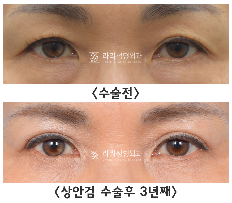 [라리성형외과] 눈꺼풀 처짐 개선하는 상안검수술, 무쌍상안검성형도 가능 관련 이미지 4