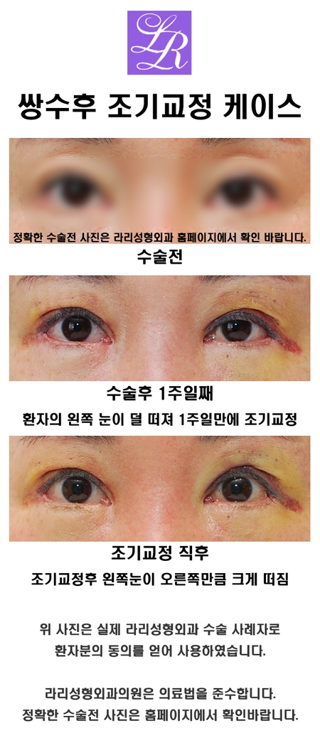 How Long It Takes to Have Double Eyelid Surgery a Second Time After a Failed First Surgery image 5