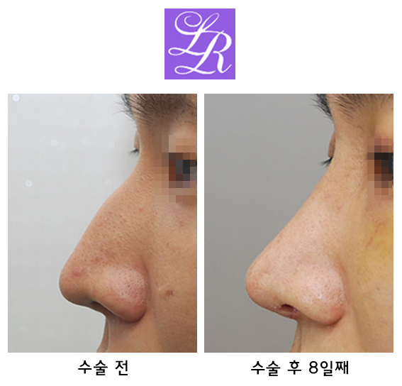 휘어진코? 휜코? 매부리코? 메부리코? 교정 관련 이미지 4