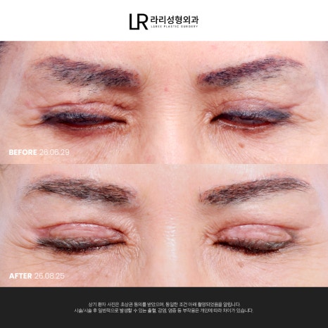 [라리성형외과]  부리부리한 사백안 눈 토안, 이런 눈도 교정 가능할까요 ? 관련 이미지 6