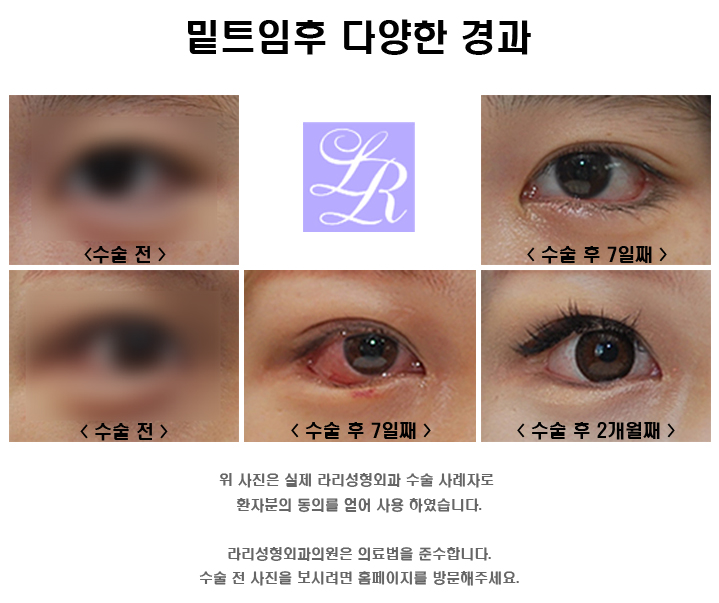 If You're Curious About Side Effects of Lower Eye Corner Surgery (feat. Conjunctival Edema) image 4