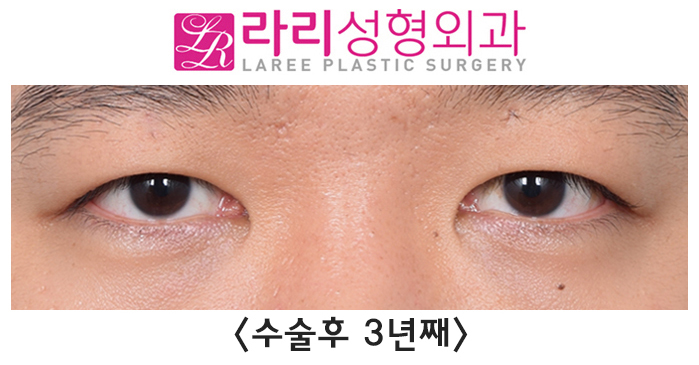 [Rari Plastic Surgery] Causes of Uneven Eye Size After Double Eyelid Removal Surgery, Cases That Naturally Even Out, Before-and-After Photos image 5