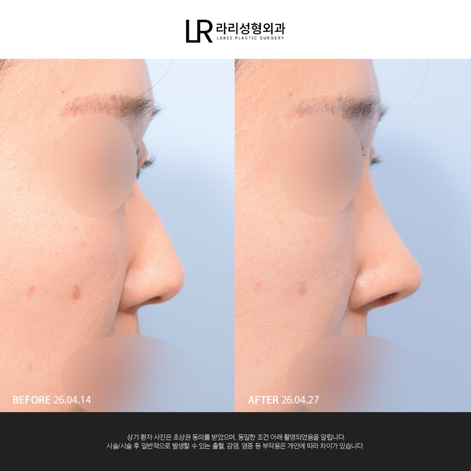 [Lari Plastic Surgery] If You Are Considering Nose Surgery, Do Not Get Nose Thread-Lifting Procedures Like Misko / Hiko!! image 8