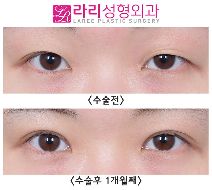 [Lari Plastic Surgery] One-sided Eye Asymmetry Incisional Double Eyelid Surgery with Ptosis Correction: Before-and-After Photos One Month After Surgery image 1