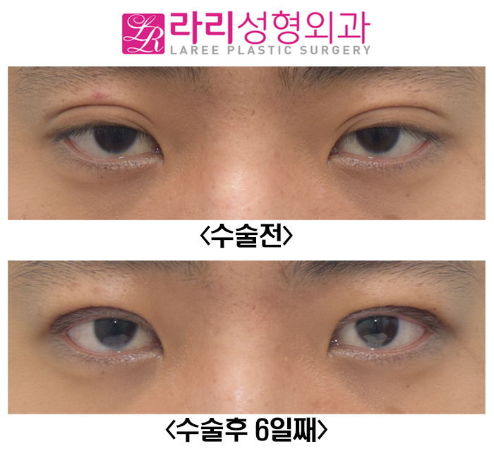 [라리성형외과] 남자 졸려보이는눈 눈매교정 수술 전후 관련 이미지 1