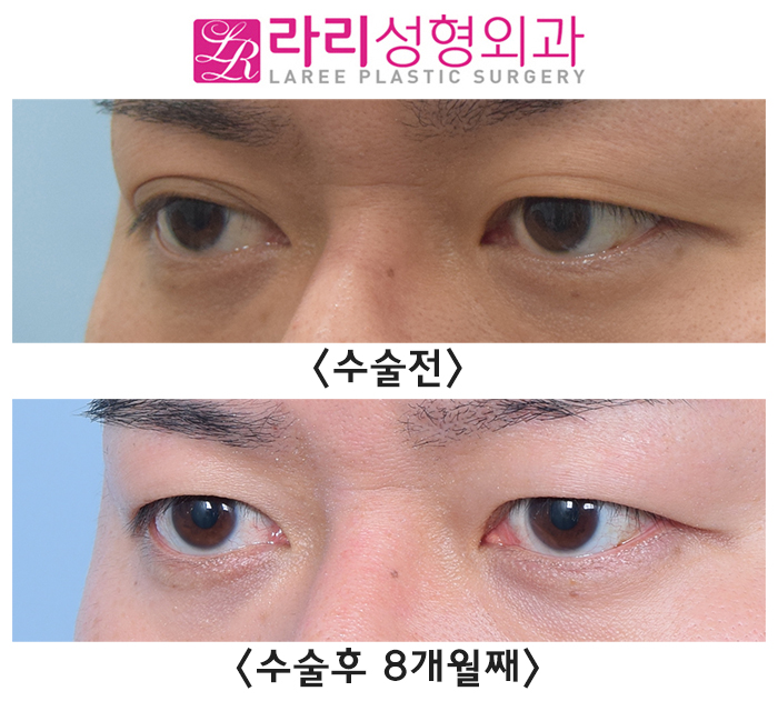 [Lari Plastic Surgery] Double Eyelid Removal Surgery That Completely Removes the Double Eyelid Line image 2