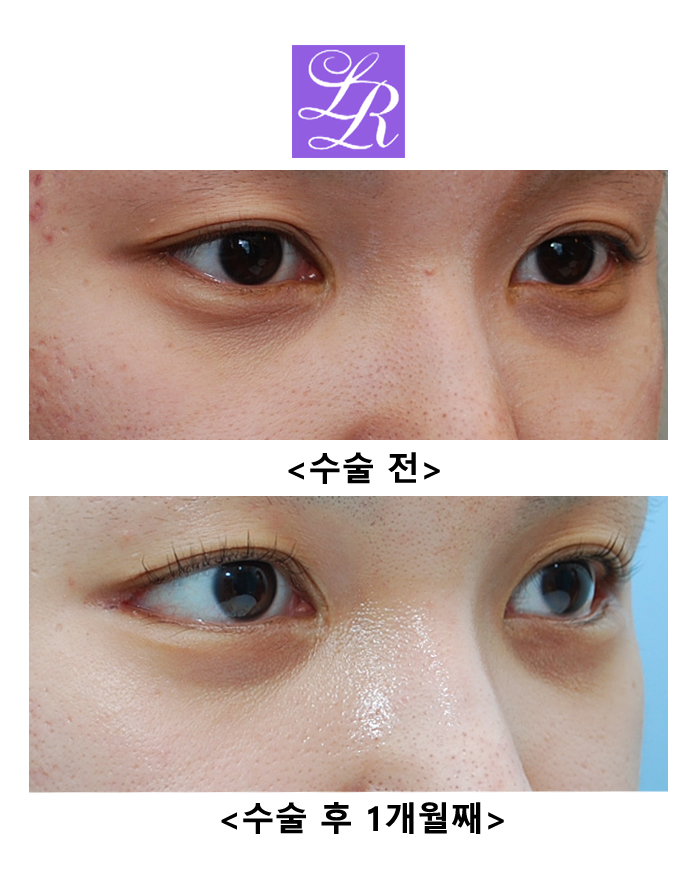Before and After Lateral Canthoplasty (Close-up Photos - Scar at the Outer Corner Visible!) image 3