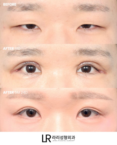 [Lari Plastic Surgery] Swelling After Double Eyelid Surgery: Why Does It Go Down Differently on Each Side? Will It Eventually Even Out? image 3