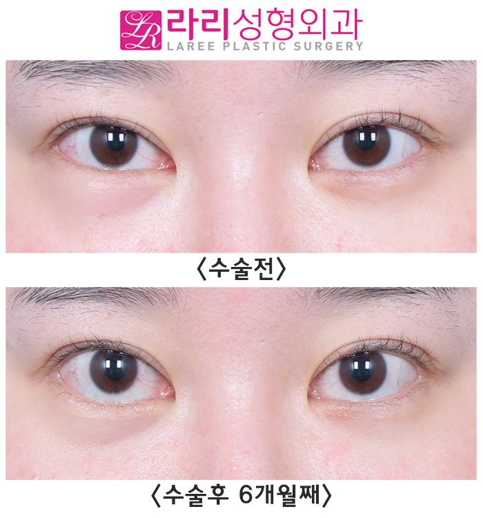 [라리성형외과] 눈밑이물질(스컬트라)제거 수술 전후 사진 차이 관련 이미지 1