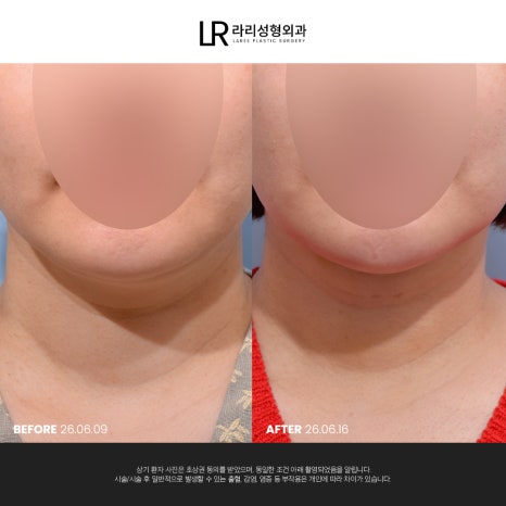 [라리성형외과] 이중턱 지방 흡입만으로는 아쉬운 얼굴 라인, 이중턱 근육 묶기도 같이 하면 효과가 두 배! 관련 이미지 14