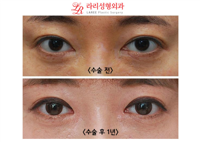 앞트임 복원 전후사진 (수술 2개월후와 1년후) 관련 이미지 4