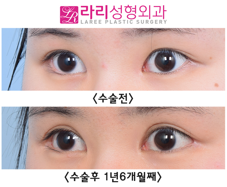 [Rari Plastic Surgery] Comparing the Before-and-After Effects of Lateral Canthoplasty Performed Together with Incisional Double Eyelid Surgery image 3