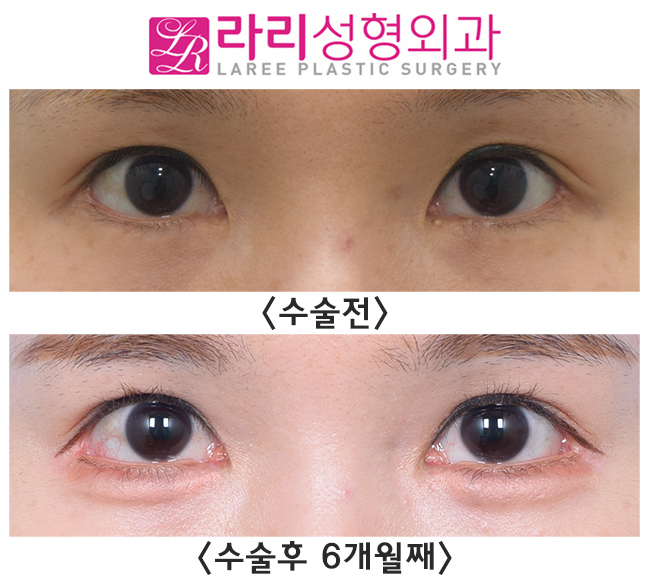 [라리성형외과] 효과 못 본 트임수술, 제대로 터주는 재수술로 유명한 이유가 있습니다. 관련 이미지 1
