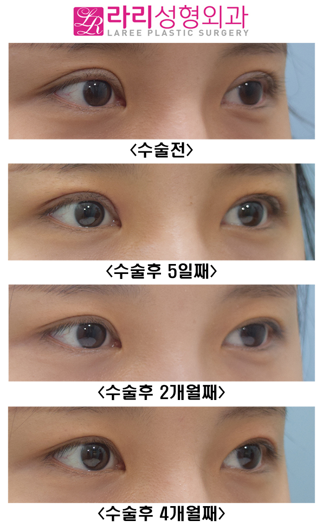 [Lari Plastic Surgery] Revision Double Eyelid Surgery to Correct Mucosal Exposure Caused by Sausage-Like Eyelids image 6