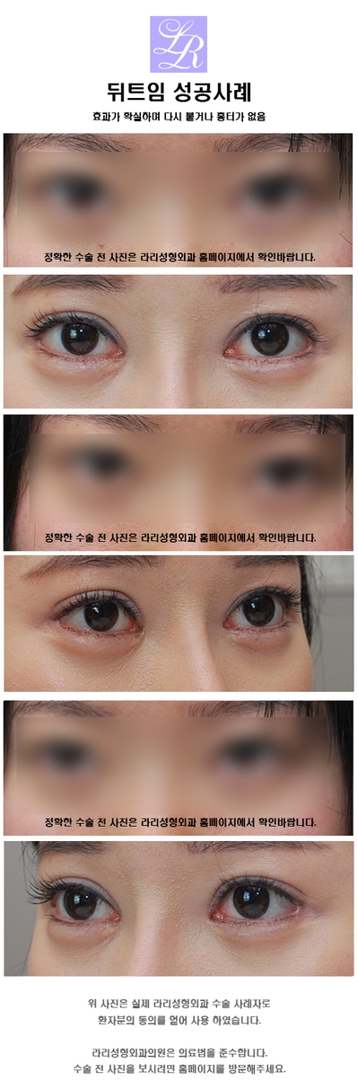 뒤트임재수술 - 첫수술이 효과가 없던 경우, 부작용? 관련 이미지 4