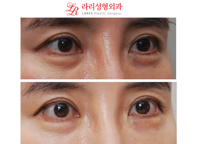 꽃중년 바비밑트임 수술전후사진 관련 이미지 3