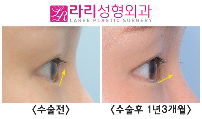 [라리성형외과] 안검내반과 안검외반, 무엇이 다를까 ? 관련 이미지 5