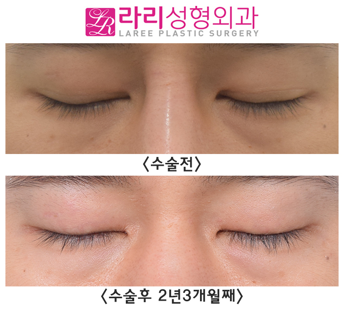 [Rari Plastic Surgery] Removing Double Eyelids Completely / No Double Eyelids When Eyes Are Open, No Double Eyelids When Eyes Are Closed image 5
