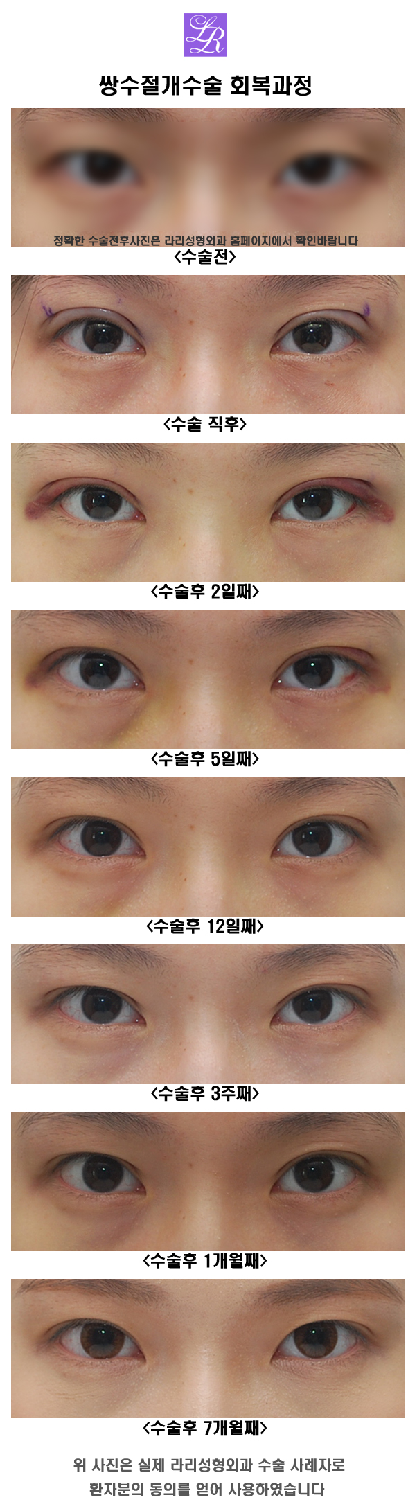티안나는 쌍수 매몰법, 절개법 선택하기 관련 이미지 6