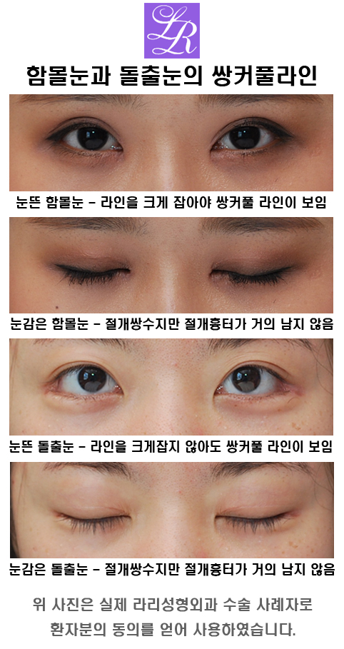 쌍커풀 라인, 예쁘게 한 후기 관련 이미지 2