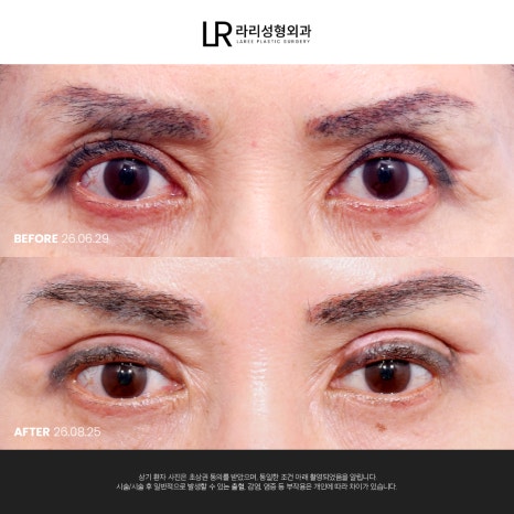 [라리성형외과]  부리부리한 사백안 눈 토안, 이런 눈도 교정 가능할까요 ? 관련 이미지 5