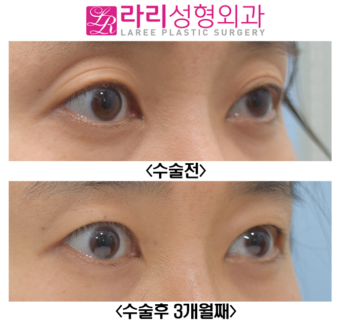 [라리성형외과] 윗눈꺼풀 주름 같은 애매한 쌍꺼풀 무쌍 만드는 수술 관련 이미지 2