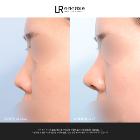 [Lari Plastic Surgery] If You Are Considering Nose Surgery, Do Not Get Nose Thread-Lifting Procedures Like Misko / Hiko!! image 15