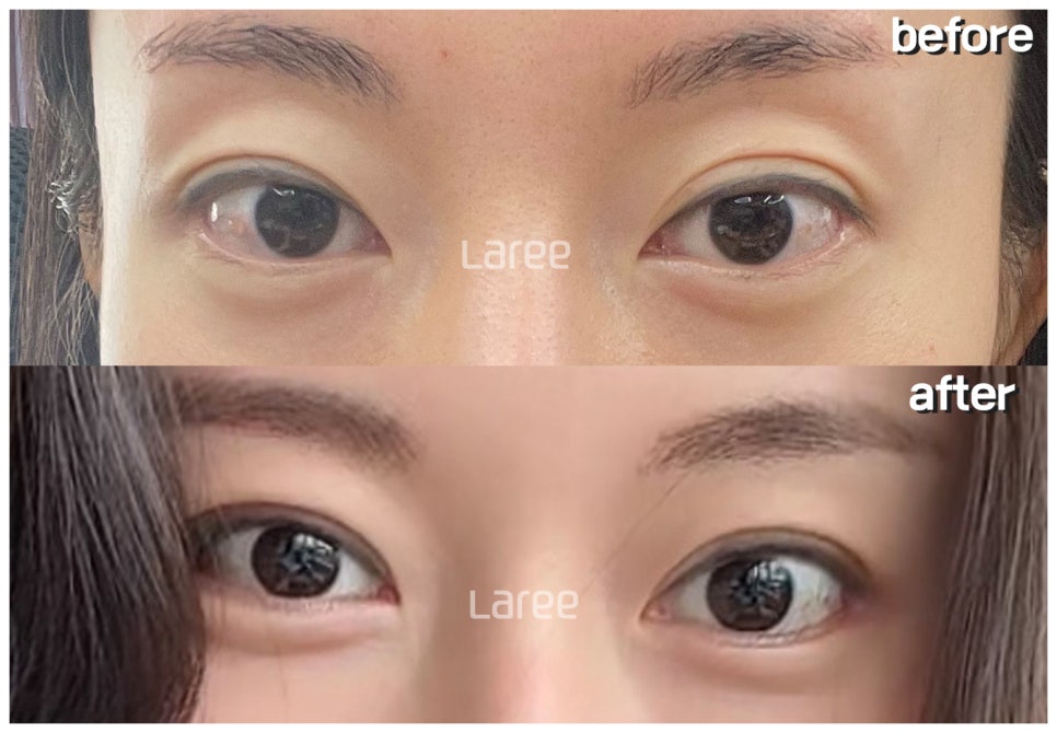 [Lari Plastic Surgery] The Real Way to Make Eyes Bigger: Eyelid Correction Surgery Is Needed Before Canthoplasty. image 7