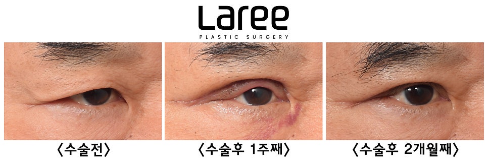 [Rari Plastic Surgery] After Eye Surgery, Is Mucosal Show Normal?! image 2