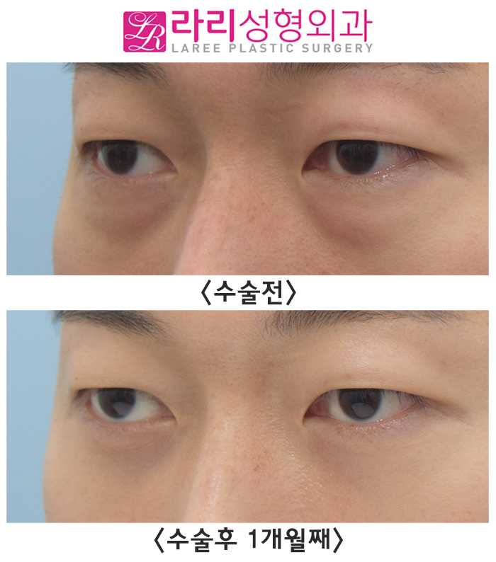 [라리성형외과] 간단해 보이지만 그렇지 않은 눈밑지방재배치수술 전후사진 관련 이미지 1