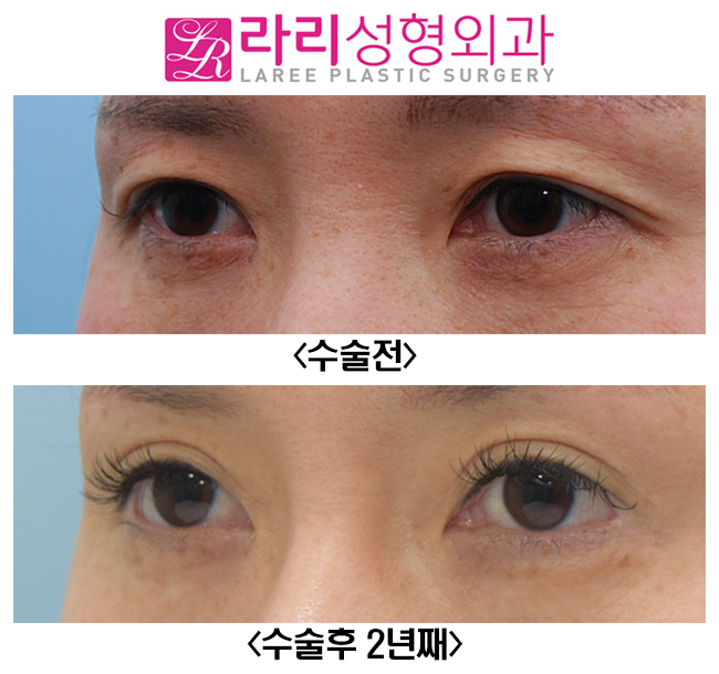 [라리성형외과] 아웃라인 쌍꺼풀재수술 화려하게 변화주기 관련 이미지 3