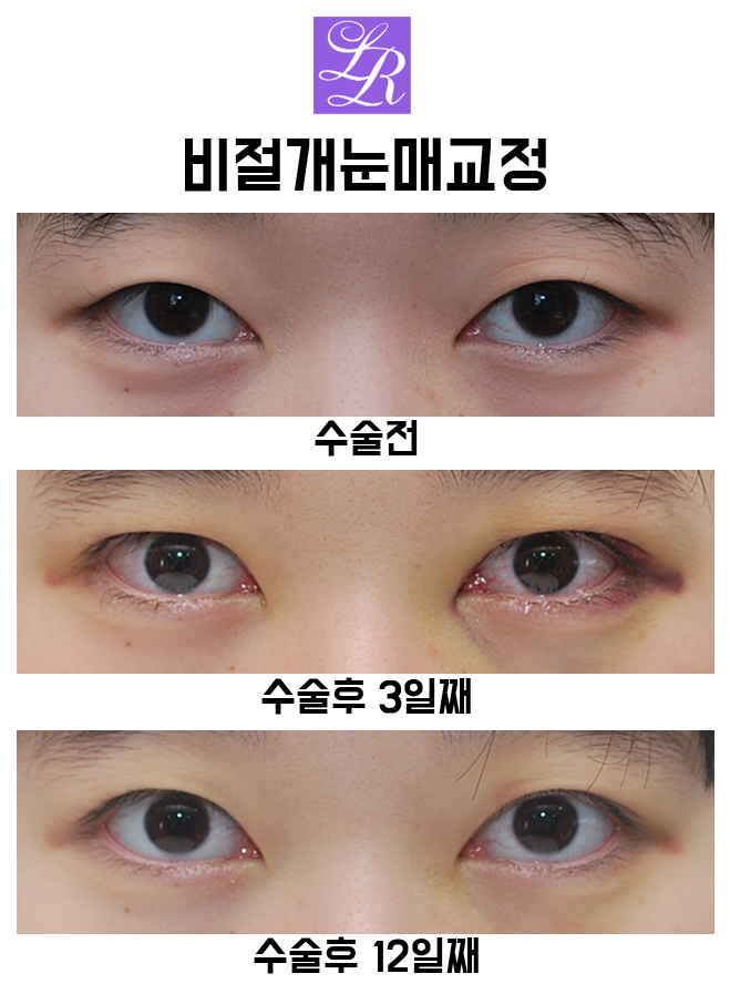 자연스러운 안검하수 교정  -무쌍눈매교정, 비절개눈매교정 관련 이미지 4