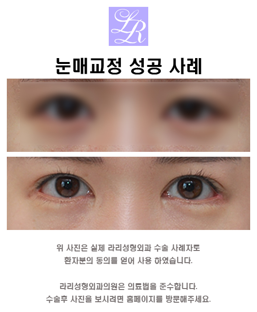 안검하수 눈매교정술 해야하는 경우 관련 이미지 5
