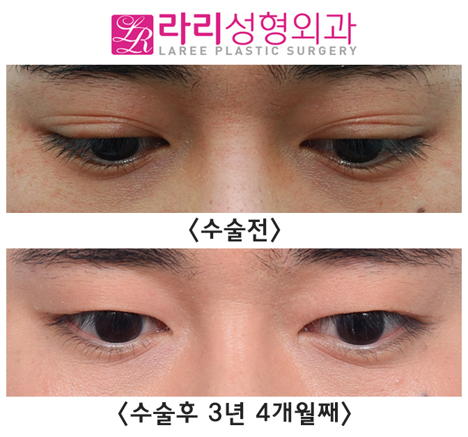 [라리성형외과] 매몰 쌍수, 쌍꺼풀 없애는 수술 장기 경과 전후 사진 그리고 실제  동영상 관련 이미지 2