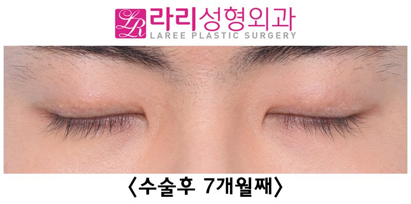 [라리성형외과] 쌍꺼풀없애기 수술 눈안감김(토안)의 원인이 정말 피부절제 때문일까? - 무절제쌍꺼풀없애기 관련 이미지 16