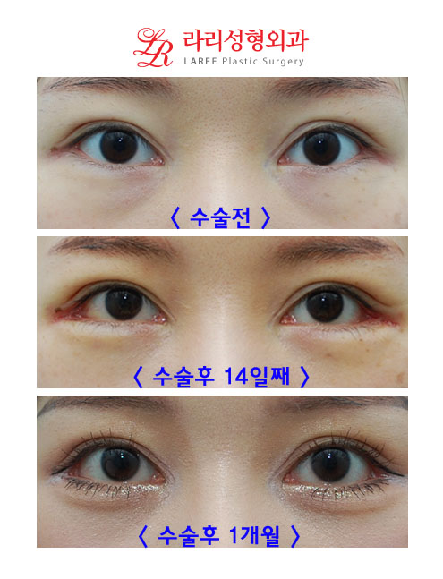 뒷트임재수술, 눈밑지방재배치 콜라보 관련 이미지 1