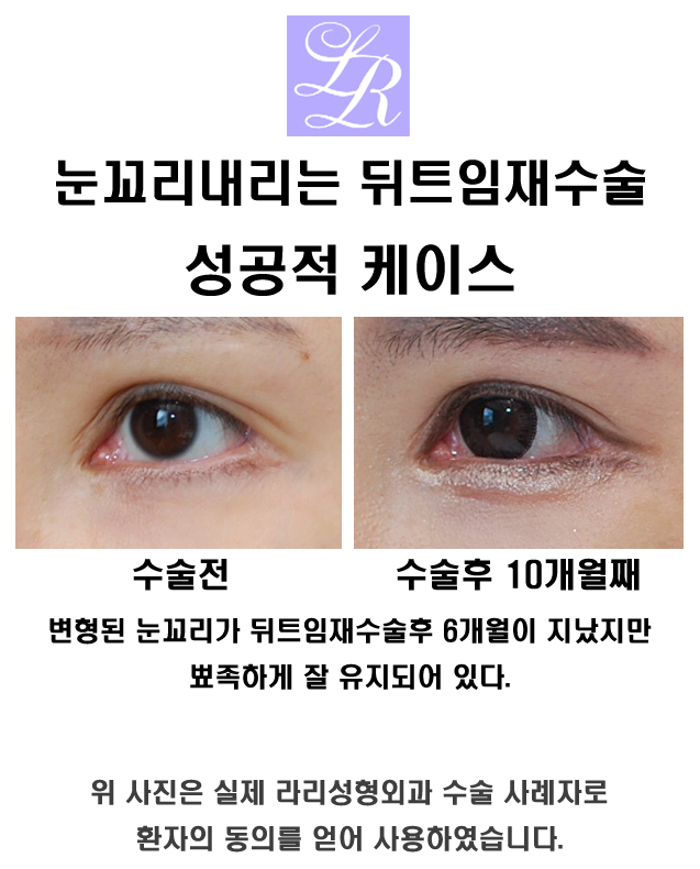 뒤트임재수술로 흉터 부작용 교정하기 관련 이미지 7
