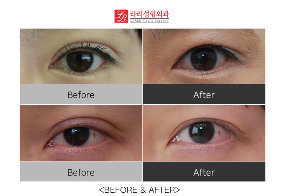 Correcting Double Eyelid Surgery Side Effects: Ectropion (feat. Rari Plastic Surgery) image 7
