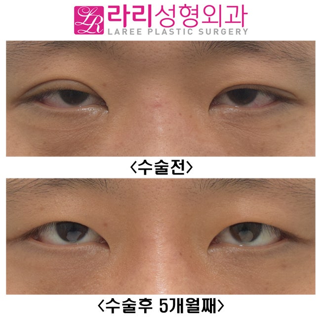 [라리성형외과] 쌍꺼풀없애기 무쌍눈매교정 수술 셀카 전후 비교 관련 이미지 1