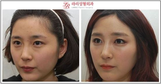Lateral Canthoplasty / Outer Corner Canthoplasty / Outer Eye Corner Lowering Canthoplasty Before and After Photos image 2