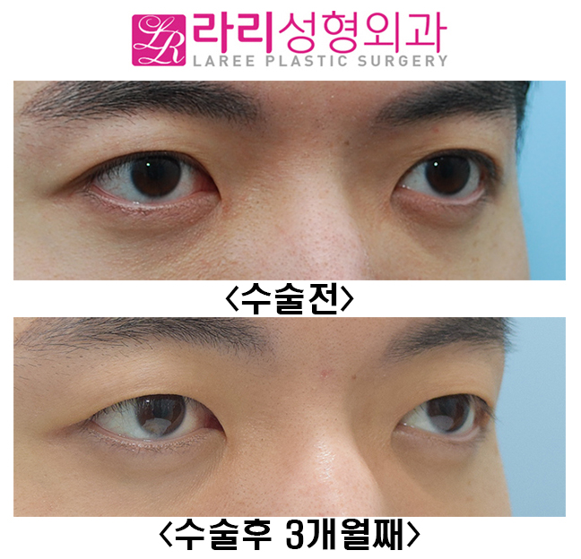 [Lari Plastic Surgery] Before-and-After Photos of Male Double Eyelid Removal Surgery at 3 Months image 4