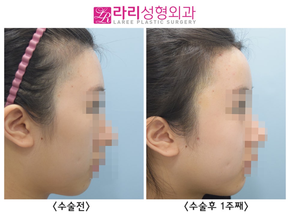 [Rari Plastic Surgery] Facial Fat Grafting (Forehead, Cheeks) Before-and-After Photos: 1-Week Progress image 4