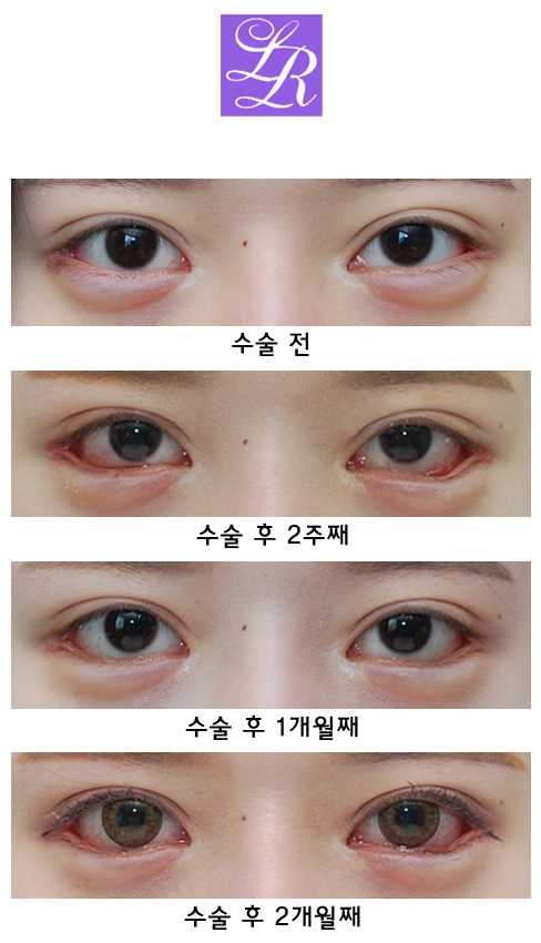 Long-Term Follow-Up Review Confirming the Effect of Lower Canthoplasty image 4